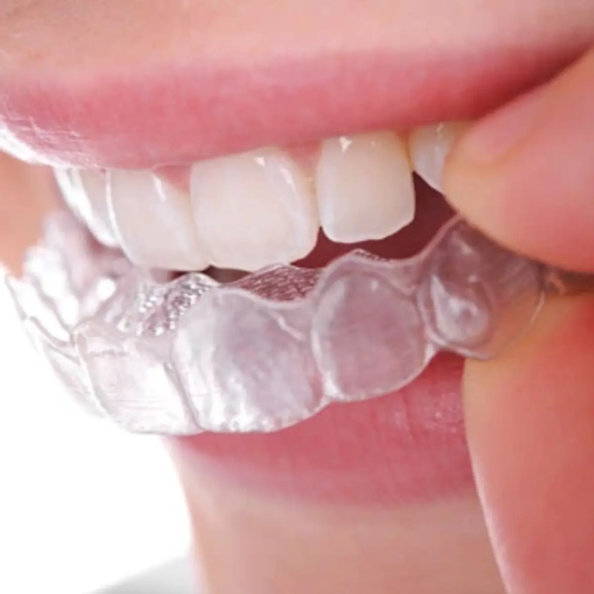Clear Aligner